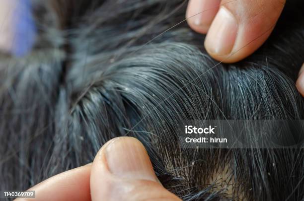 Как выглядят блохи у человека в волосах Как выглядят блохи у человека в волосах