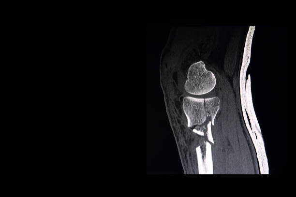 istock CT scan of a knee 1140483090
