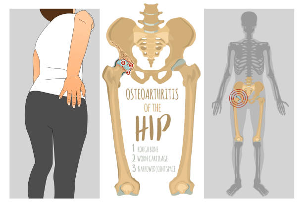 Hip Osteoarthritis Infographic Hip Osteoarthritis Infographic. Realistic bones scheme. Lower back and joint pain. Editable vector illustration isolated on a light background. Medical, healthcare, elderly diseases graphic concept. woman feet bed stock illustrations