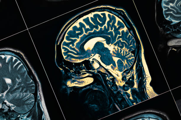 resonancia magnética de la cabeza del paciente de cerca. una imagen de la serie - alzheimer fotografías e imágenes de stock