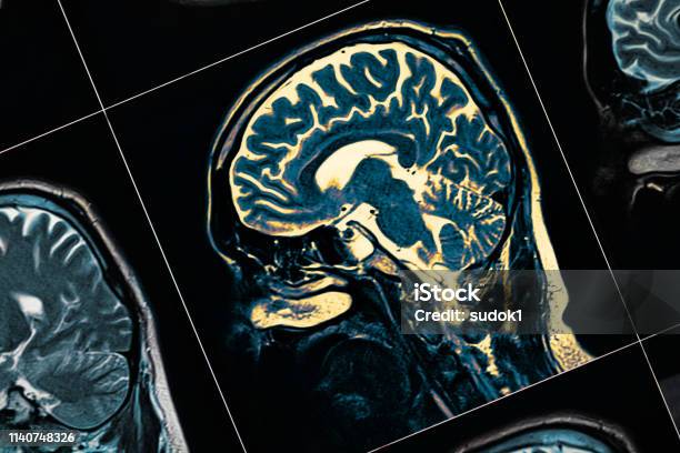 Mri Of The Patients Head Closeup One Picture From The Series Stock Photo - Download Image Now