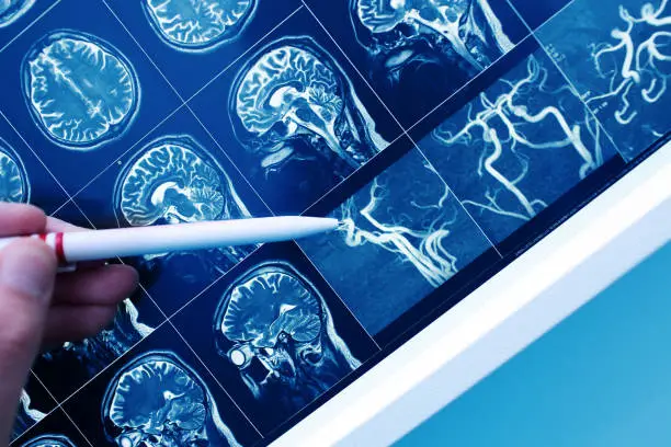 Photo of Doctor pointing with pen to the brain blood vessel on the MRI image