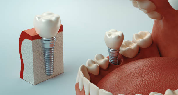 soins dentaires - implant photos et images de collection