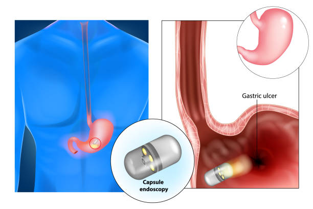 kapsel endoskopie (auch pille cam) - endoskop stock-grafiken, -clipart, -cartoons und -symbole