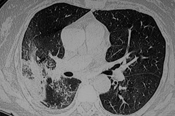 istock Pneumonia Lung infection. X Ray 1140844896