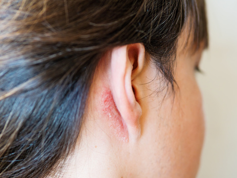 Irritación en la piel detrás de la oreja. Hombre con piel escamosa. Alergia o enfermedad fúngica. photo