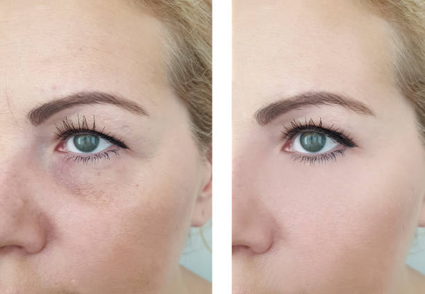 istock woman wrinkles before and after correction procedures 1141027952