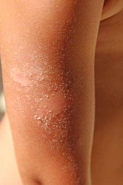 istock burn on hand after sunburn. Traces of sunburn on arm 1141048913