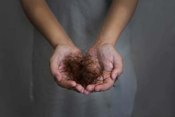 A woman suffering from hair loss. Balding. stock photo
