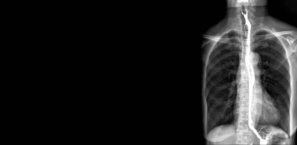 esophagramm oder barium-schwalbe ap-ansicht ist ein röntgenbild der speiseröhre, trinkt der patient eine flüssigkeit, die barium enthält. die flüssigen schichten der speiseröhre und röntgenstrahlen werden für die suche nach krebs genommen. - barium stock-fotos und bilder