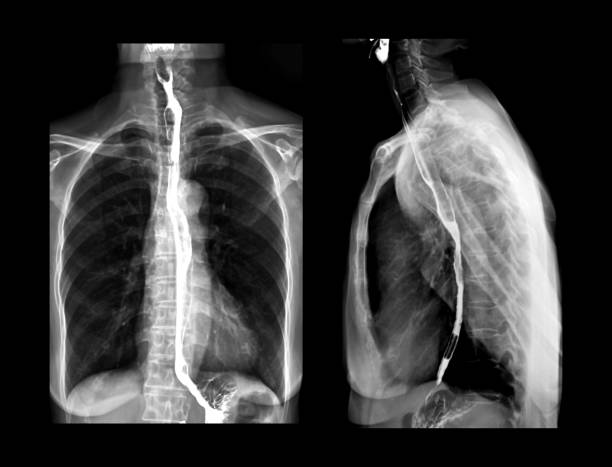 esophagram またはバリウム飲み込む ap および側面図は、食道の x 線であり、患者はバリウムを含有する液体を飲む。液体は食道をコートし、x 線は取られる。 - barium ストックフォトと画像