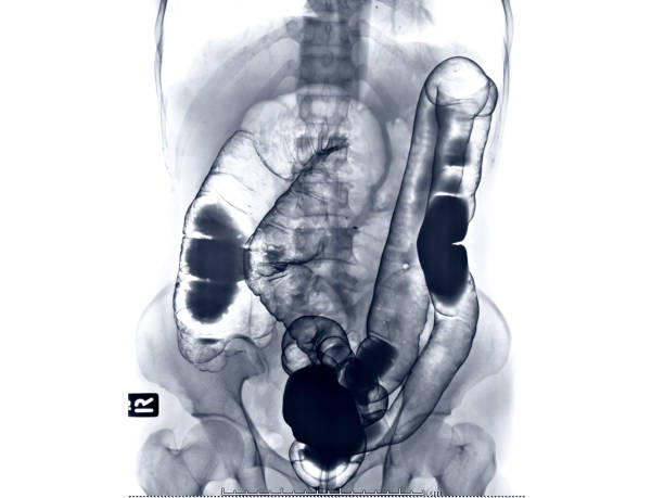 barium-einlauf-bild oder röntgenbild der dickdarm-ap-ansicht zeigt anatomisch von dickdarm oder dickdarm für die diagnose darmkrebs. - barium stock-fotos und bilder