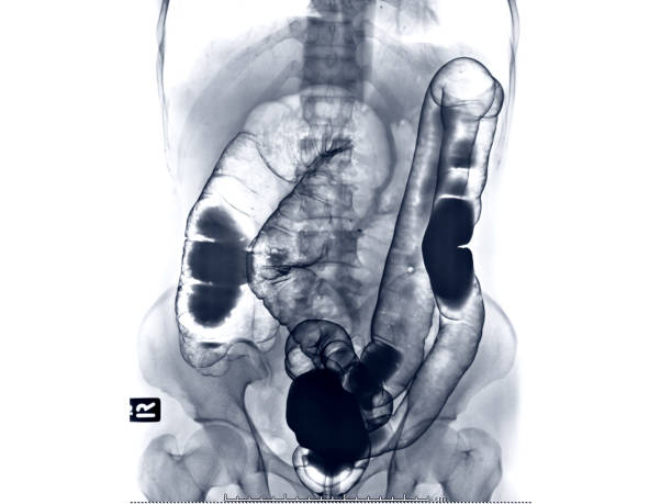 大腸癌の診断のための小腸または結腸の解剖学的所見を示す小腸の腸内画像または x 線画像 - barium ストックフォトと画像