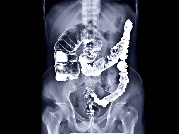 b.e. oder barium-einlaufbild oder röntgenbild von dickdarm-ap-ansicht, die anatomisch von dickdarm oder dickdarm für die diagnose colorectalkrebs zeigt. - barium stock-fotos und bilder