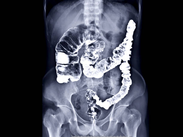 image d’lavement de baryum ou de baryum ou image de rayon x du grand intestin vue ap montrant anatomiques du gros intestin ou du côlon pour le diagnostic cancer colorectal. - hydrothérapie photos et images de collection