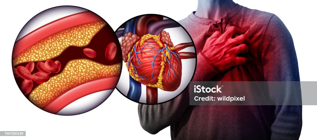 Myocardial Infarction Myocardial infarction as a person suffering from a heart attack due to clogged coronary artery as a cardiology distress symbol with 3D illustration elements. Cholesterol Stock Photo