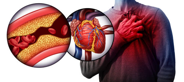 Myocardial Infarction Myocardial infarction as a person suffering from a heart attack due to clogged coronary artery as a cardiology distress symbol with 3D illustration elements. heart disease photos stock pictures, royalty-free photos & images