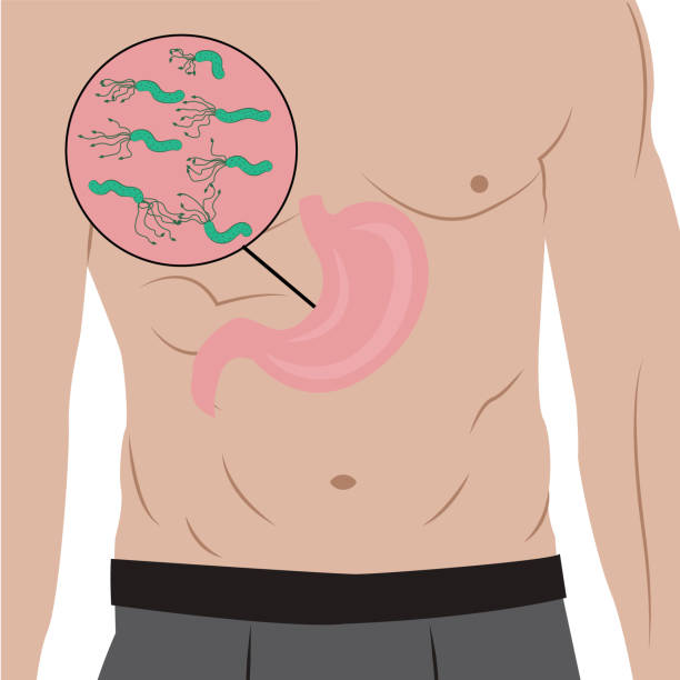 ilustraciones, imágenes clip art, dibujos animados e iconos de stock de un estómago lleno de helicobacter pylori en el cuerpo del pueblo. causa de gastritis. ilustración vectorial en estilo de dibujos animados - pylori