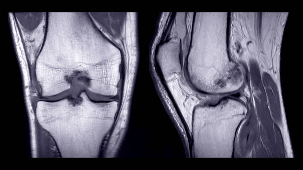 자기 공명 영상 또는 오른쪽 무릎 비교 코로나와 시상 보기의 mri. - human spine mri scan x ray doctor 뉴스 사진 이미지