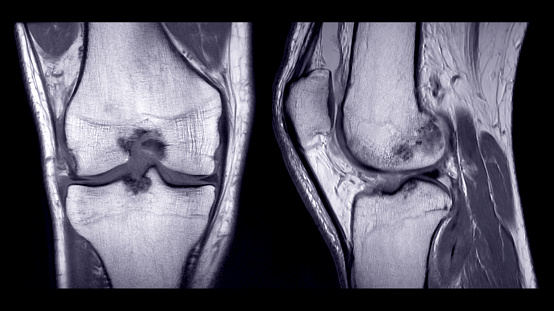 voorzien Huiswerk Verhogen Magnetic Resonance Imaging Of Mri Van De Rechter Knie Vergelijking Coronale  En Sagittale Bekijken Stockfoto en meer beelden van MRI-scan - Medische scan  - iStock