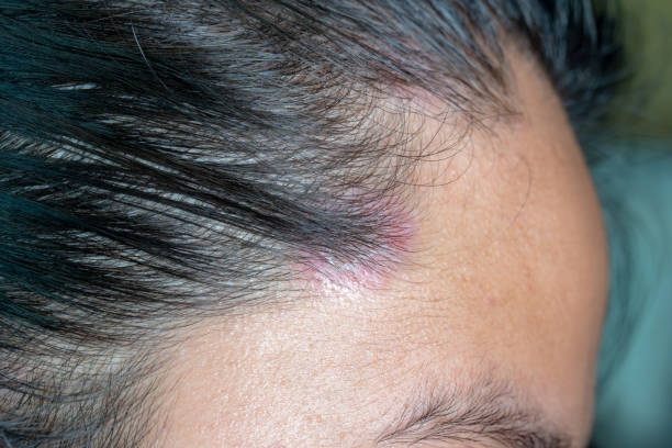 Fungal Scalp Stock Photos, Pictures & Royalty-Free Images - iStock Fungal Scalp Stock Photos, Pictures & Royalty-Free Images - iStock