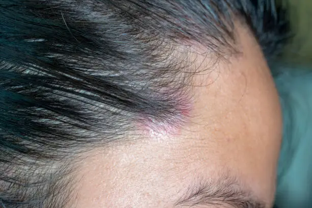 Skin diseases, on the scalp ,Close up photo of nevus sebaceus on scalp