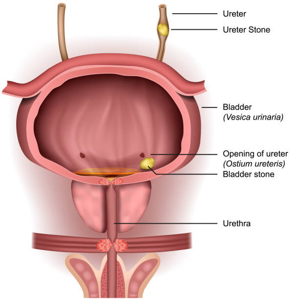 Bladder stones 3d medical vector illustration on white background Bladder stones 3d medical vector illustration on white background eps 10 ureter stock illustrations