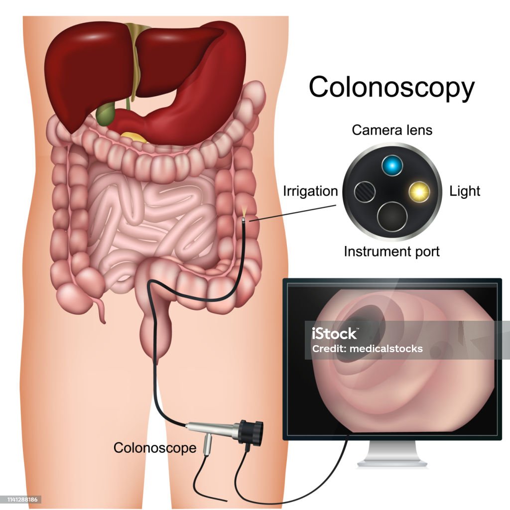 Kolonoskopie-Verfahren mit der Bezeichnung 3d-Vektordiagramm auf weißem Hintergrund - Lizenzfrei Darmspiegelung Vektorgrafik