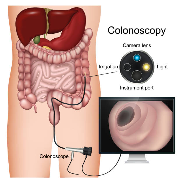 kolonoskopie-verfahren mit der bezeichnung 3d-vektordiagramm auf weißem hintergrund - endoskop stock-grafiken, -clipart, -cartoons und -symbole