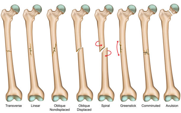 Bone fracture types medical vector illustration Bone fracture types medical vector illustration eps 10 hip body part stock illustrations