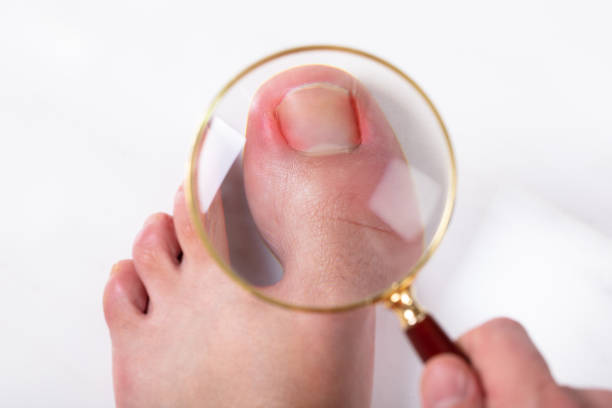 person holding magnifying glass over sore toe nail - toenail stock-fotos und bilder