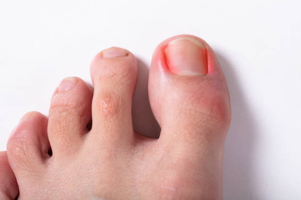 Close-up Of Sore Toe Nail An Elevated View Of Sore Toe Nail On Floor toenail stock pictures, royalty-free photos & images