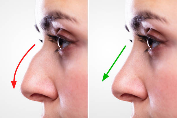 woman's nose before and after plastic surgery - nose job imagens e fotografias de stock