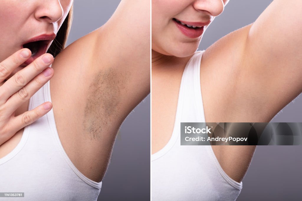 Before And After Concept Of Underarm Hair Removal Stock Photo - Download Image Now - Under the Arm, Armpit, Women - iStock Before And After Concept Of Underarm Hair Removal Stock Photo - Download Image Now - Under the Arm, Armpit, Women - iStock