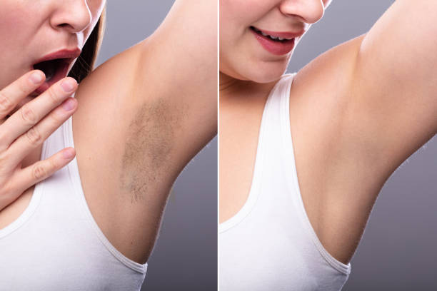 antes e depois do conceito de remoção do cabelo underarm - lingerie women spa horizontal - fotografias e filmes do acervo