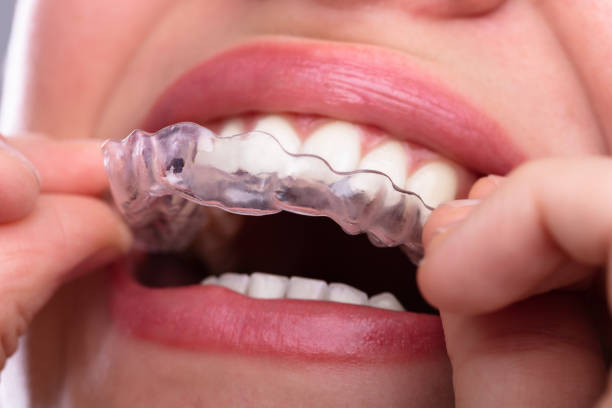 istock Woman Putting Transparent Aligner In Teeth 1141353782