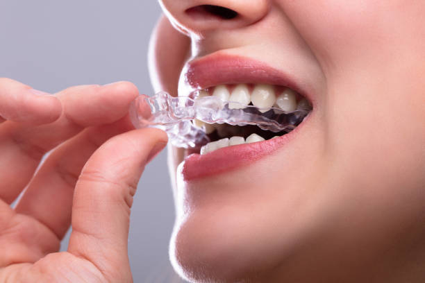istock Woman Putting Transparent Aligner In Teeth 1141353785