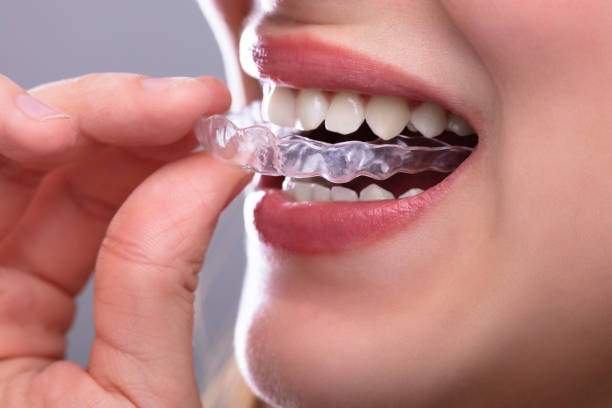 istock Woman Putting Transparent Aligner In Teeth 1141353788