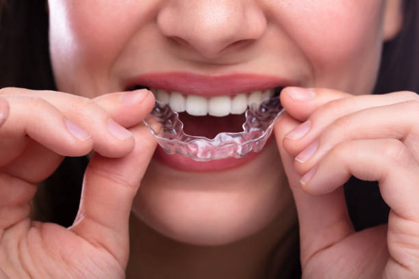 istock Woman Putting Transparent Aligner In Teeth 1141353789
