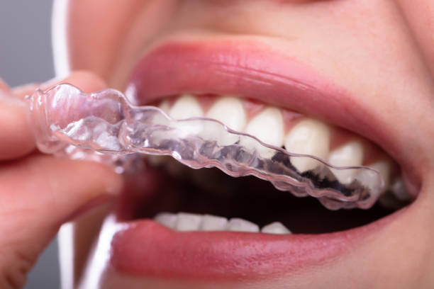 istock Woman Putting Transparent Aligner In Teeth 1141353790