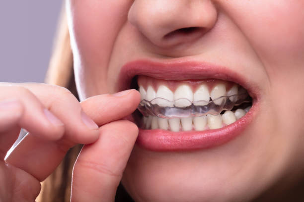 istock Woman Putting Transparent Aligner In Teeth 1141353796