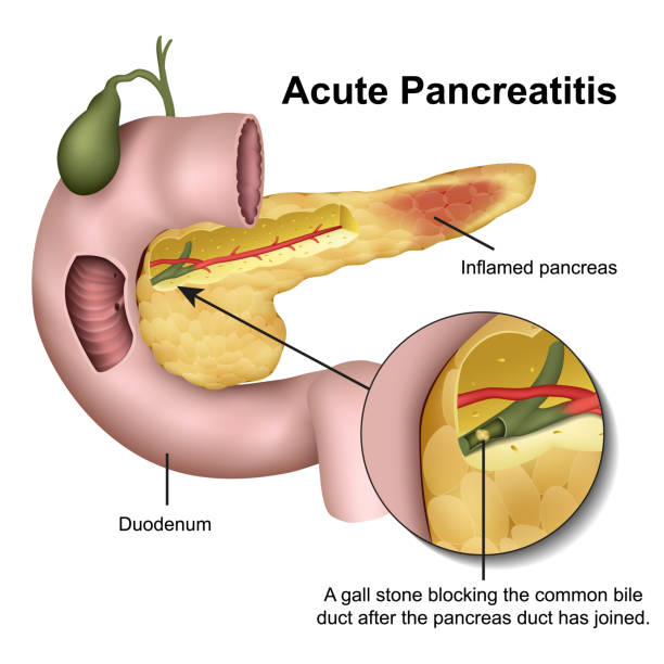 Acute pancreatitis medical illustration