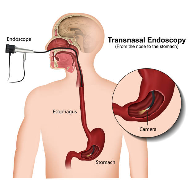 transnasale endoskopie medizinische vektordarstellung auf weißem hintergrund - endoskop stock-grafiken, -clipart, -cartoons und -symbole