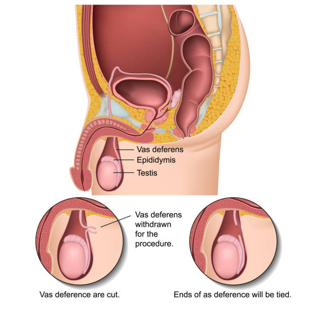 męska procedura wazektomii 3d ilustracja wektora medycznego - congenital stock illustrations