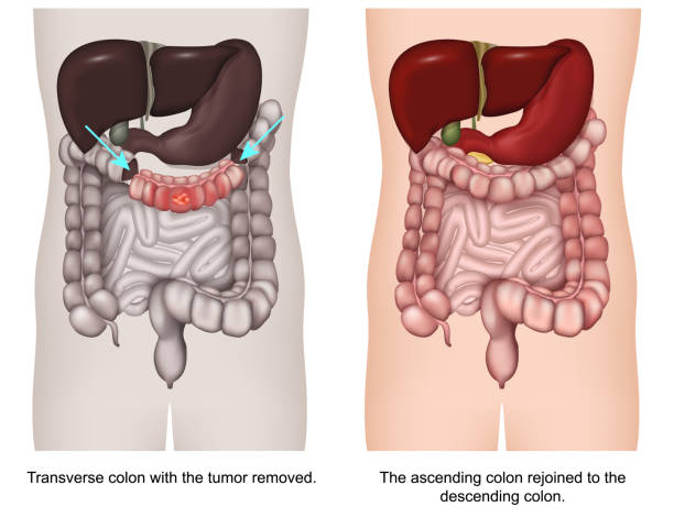 Colectomy Inking 30+ Colectomy Stock Photos, Pictures & Royalty-Free Images - iStock
