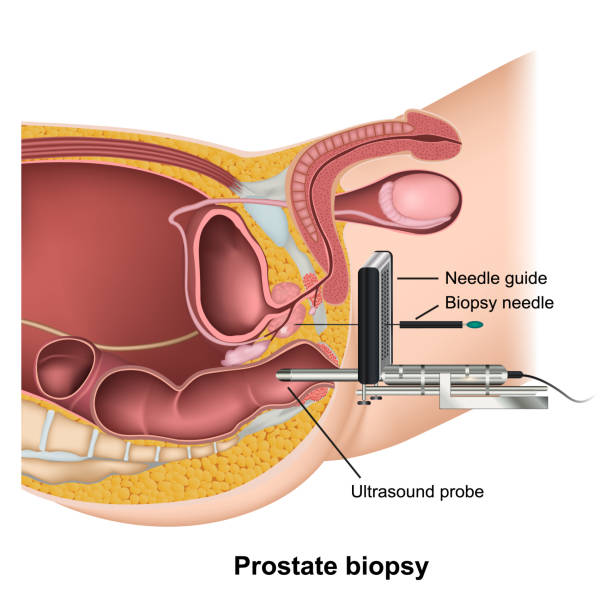 ilustraciones, imágenes clip art, dibujos animados e iconos de stock de ilustración vectorial de salud médica de biopsia de próstata sobre fondo blanco - prostate exam