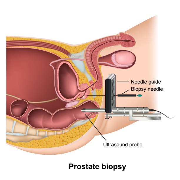 биопсия простаты медицинской иллюстрации вектор здравоохранения на белом фоне - physical checkup stock illustrations