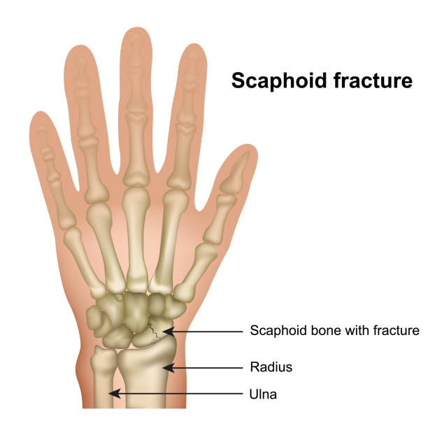 scaphoid перелом кости медицинский вектор иллюстрации на белом фоне - metacarpal stock illustrations