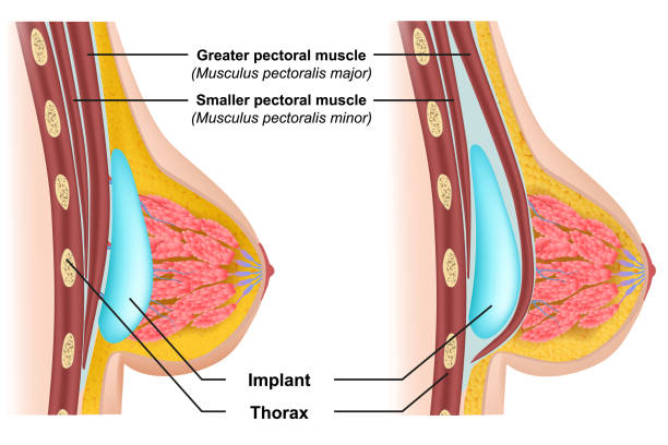 Breast implant insertion medical vector illustration Breast implant insertion medical vector illustration eps 10 silicone implants stock illustrations