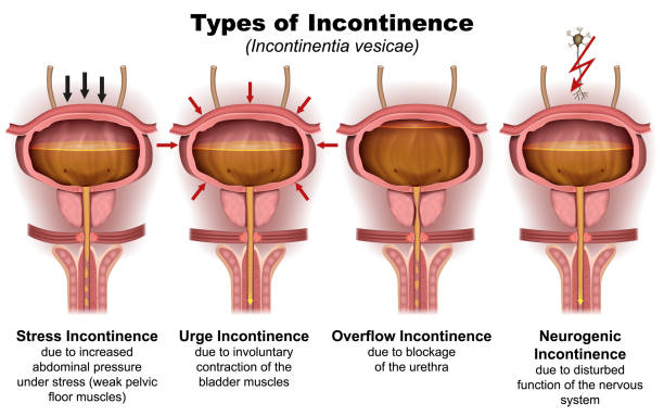 illustrations, cliparts, dessins animés et icônes de types d’incontinence illustration vectorielle médicale 3d sur fond blanc avec description en anglais - enuresis